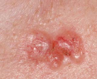 Basal Cell Carcinoma