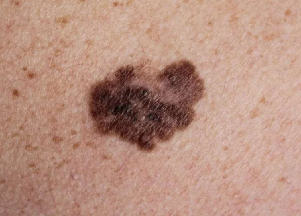 Melanoma