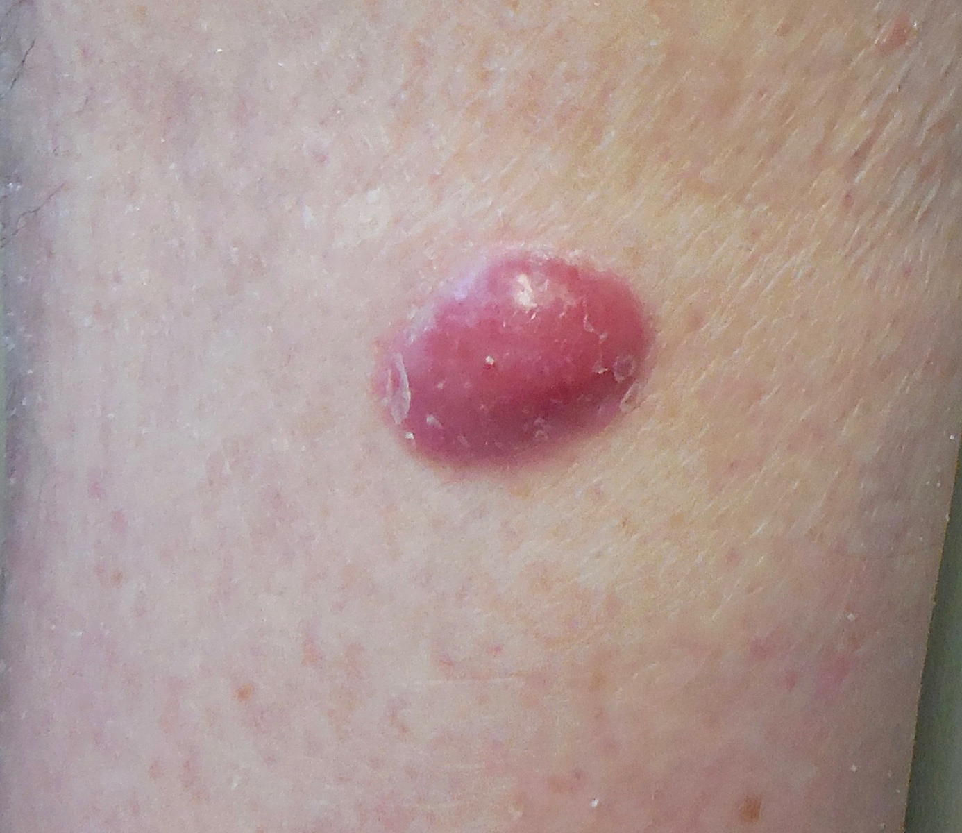 Merkel Cell Carcinoma