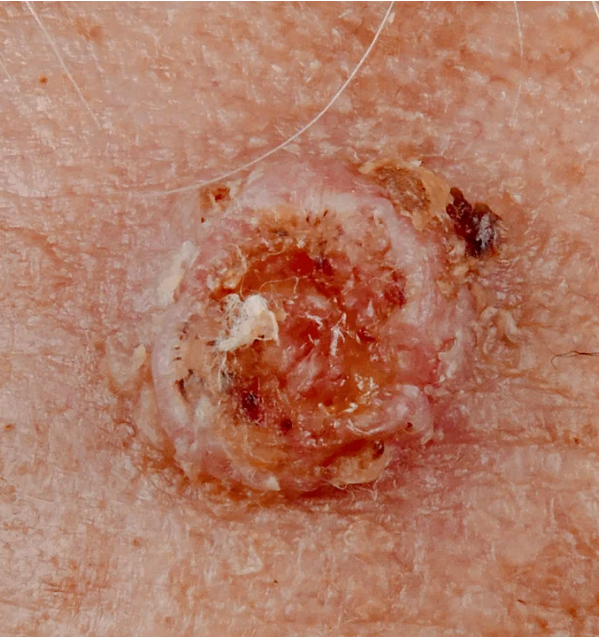 Squamous Cell Carcinoma